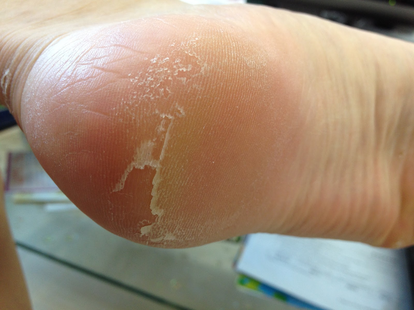 PEELING FEET ALERT Do not open if sensitive. Feet mask review Buying